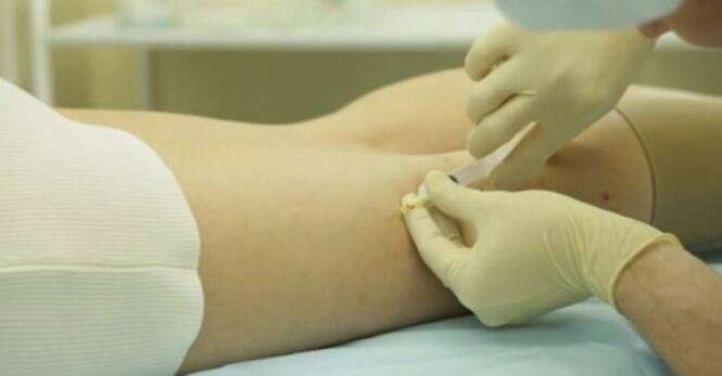 Tratamento de varizes em mulheres