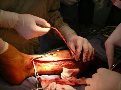 Cirurgia de veia