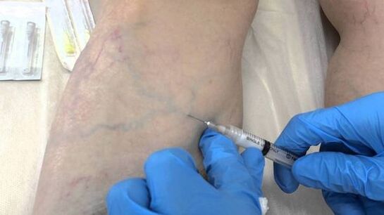 escleroterapia para varizes nas pernas em mulheres