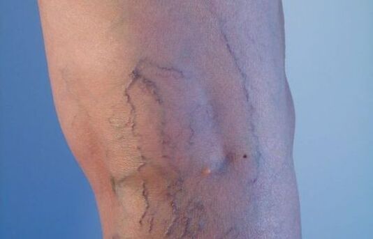 varizes nas pernas em mulheres