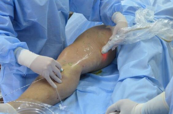 Cirurgia para remover varizes laterais