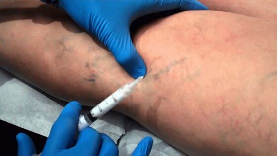 Escleroterapia para varizes