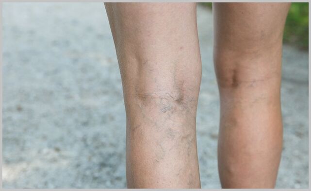 veias salientes das pernas com varizes