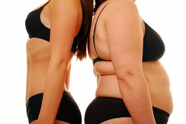 corpo magro e obesidade como causa de varizes