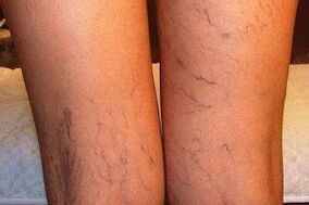 foto de varizes nas pernas
