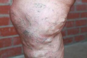 varizes avançadas